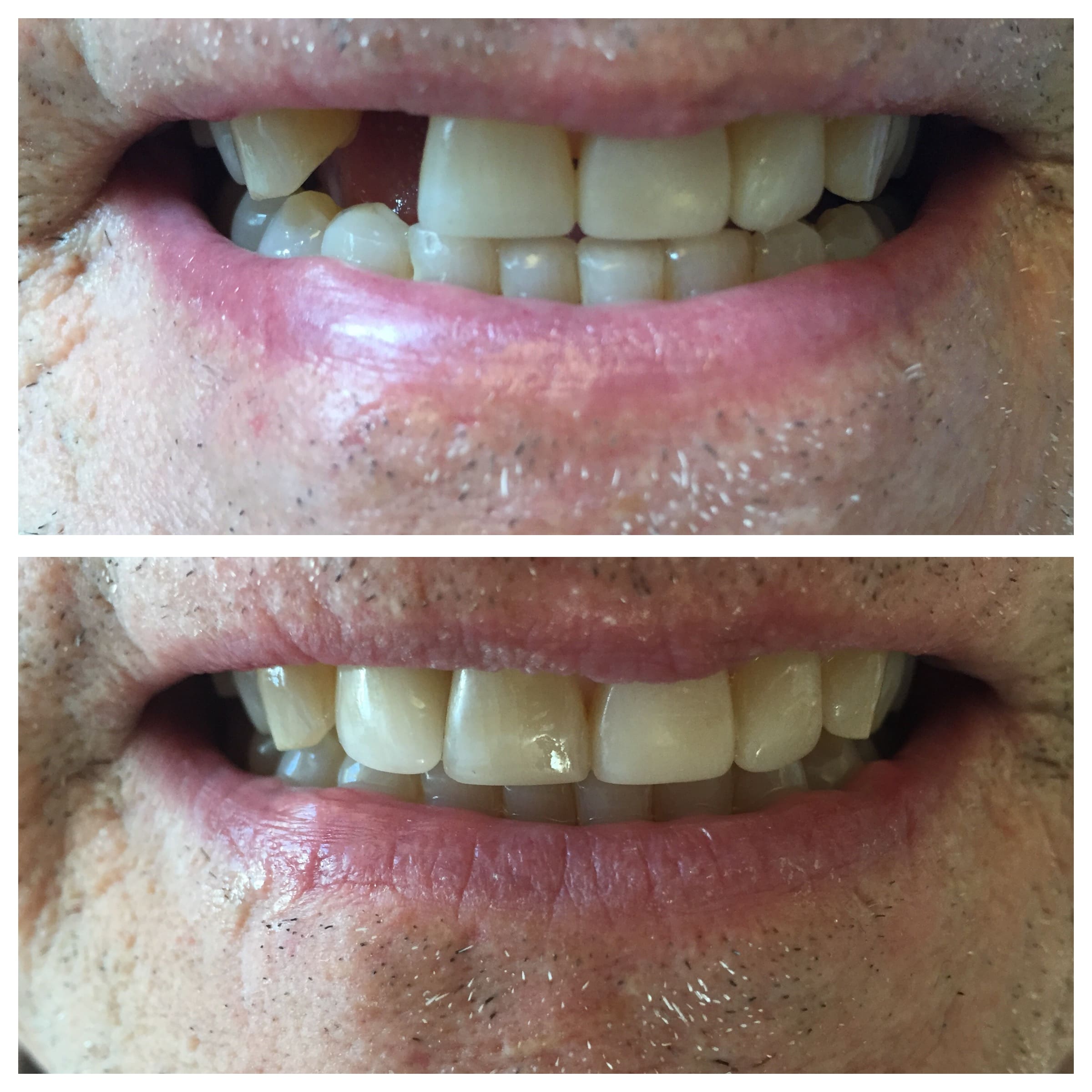 THANKS TO A DENTAL IMPLANT MY PATIENT GOT ONE OF HIS FRONT TEETH BACK!