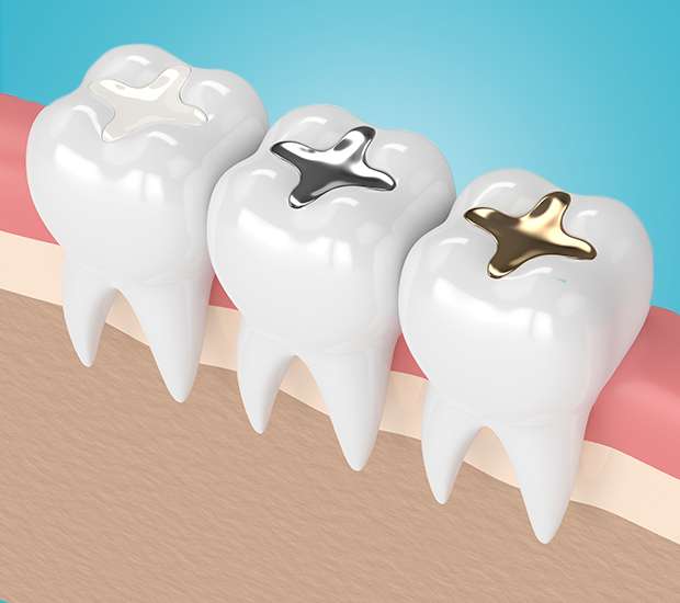 Miami Composite Fillings