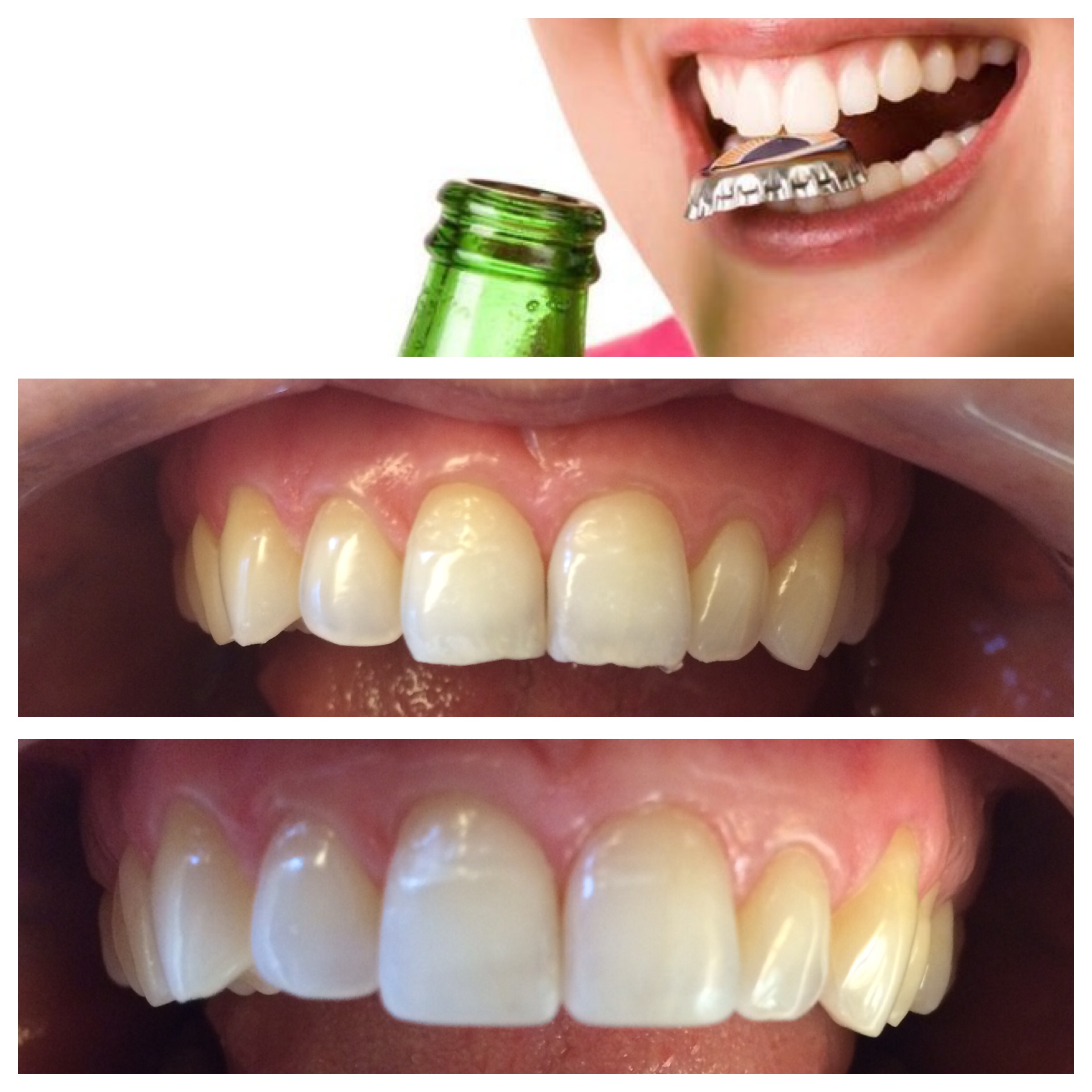 Chipped Tooth Repair with Chipped Tooth Bonding - Oral-B