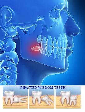 lower impacted wisdom teeth