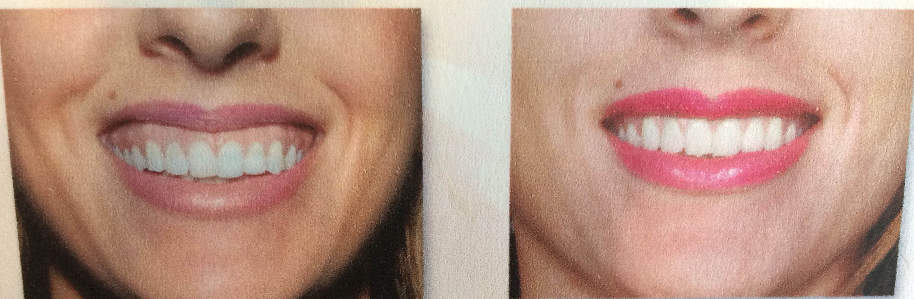 THE GUMMY SMILE, BOTOX CAN FIX IT! Dr. Rita The Smile